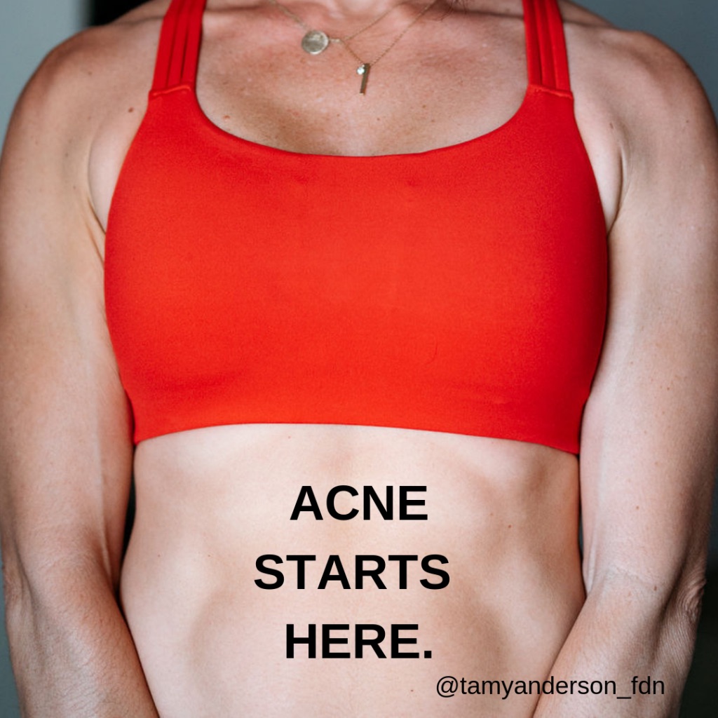 do-you-suffer-from-acne-tamy-anderson